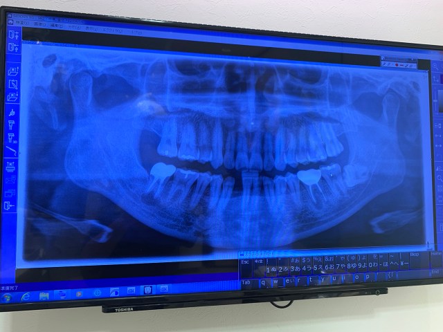 【実話】親知らずの虫歯から「アゴの骨が溶けた」体験談 / 歯医者だけはマジで定期的に行っといた方がいい理由